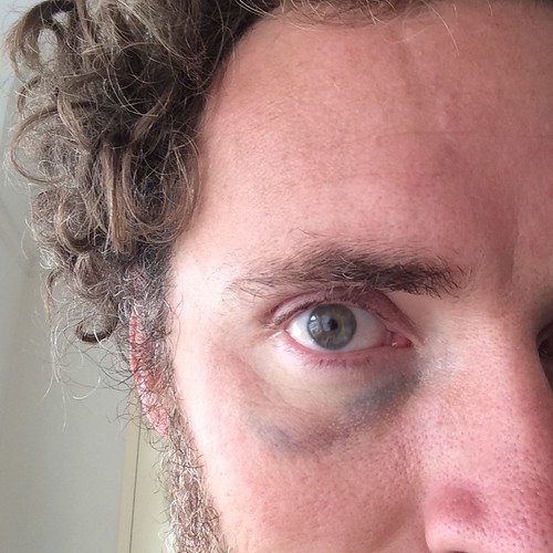 my black eye